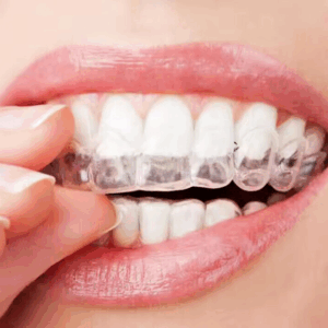 Teeth Whitening Trays