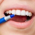 White Spot Treatment Sessions